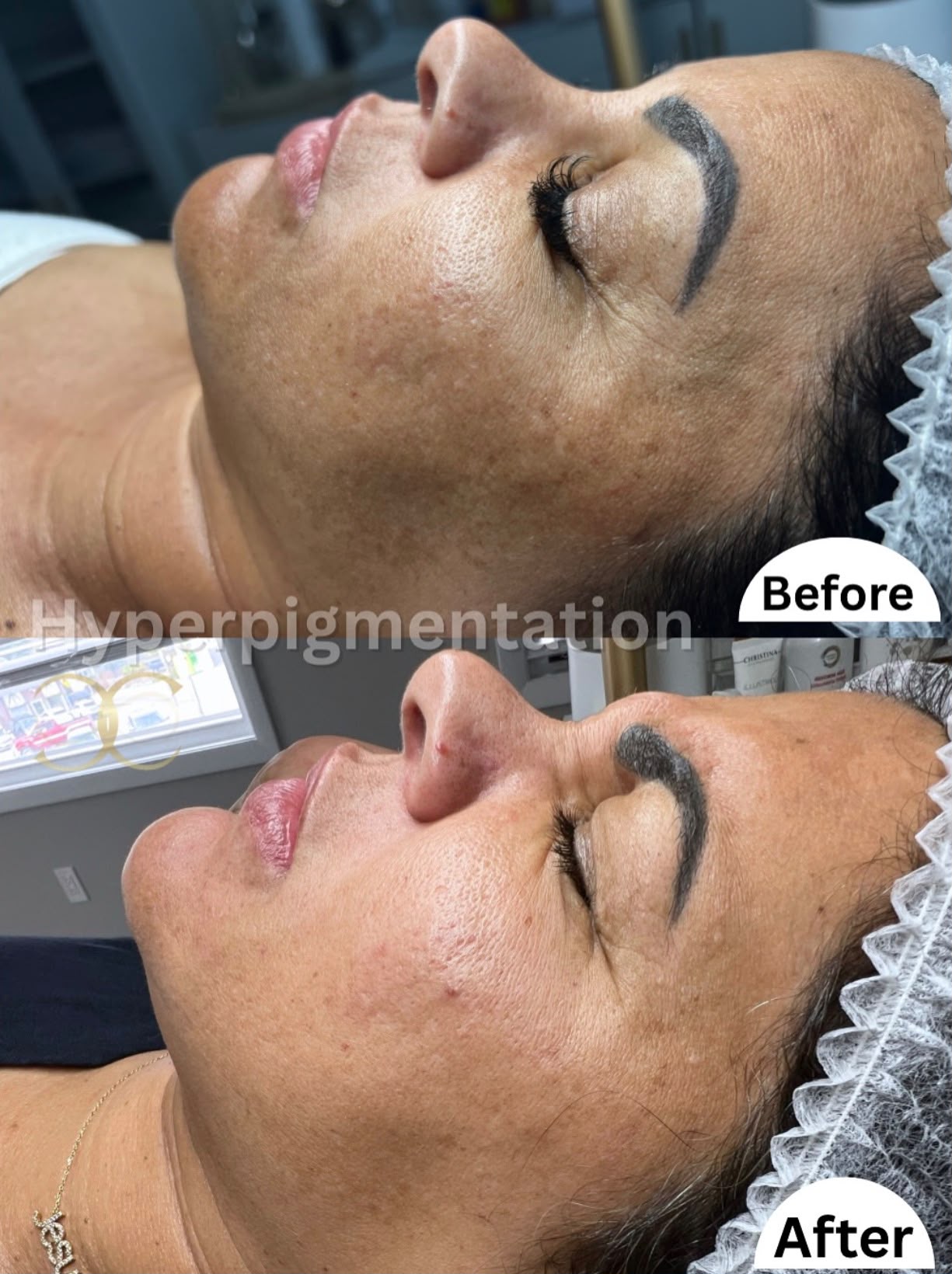 Hyperpigmentation & Melasma