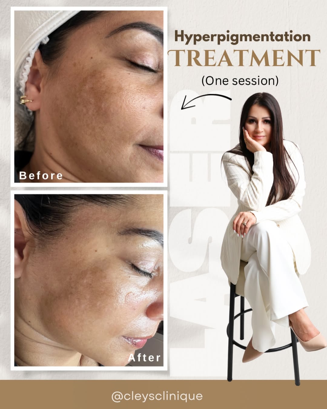 Before and after hyperpigmentation treatment results